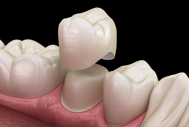 Dental crowns illustration showing tooth restoration procedure on gum model with pink tissue.