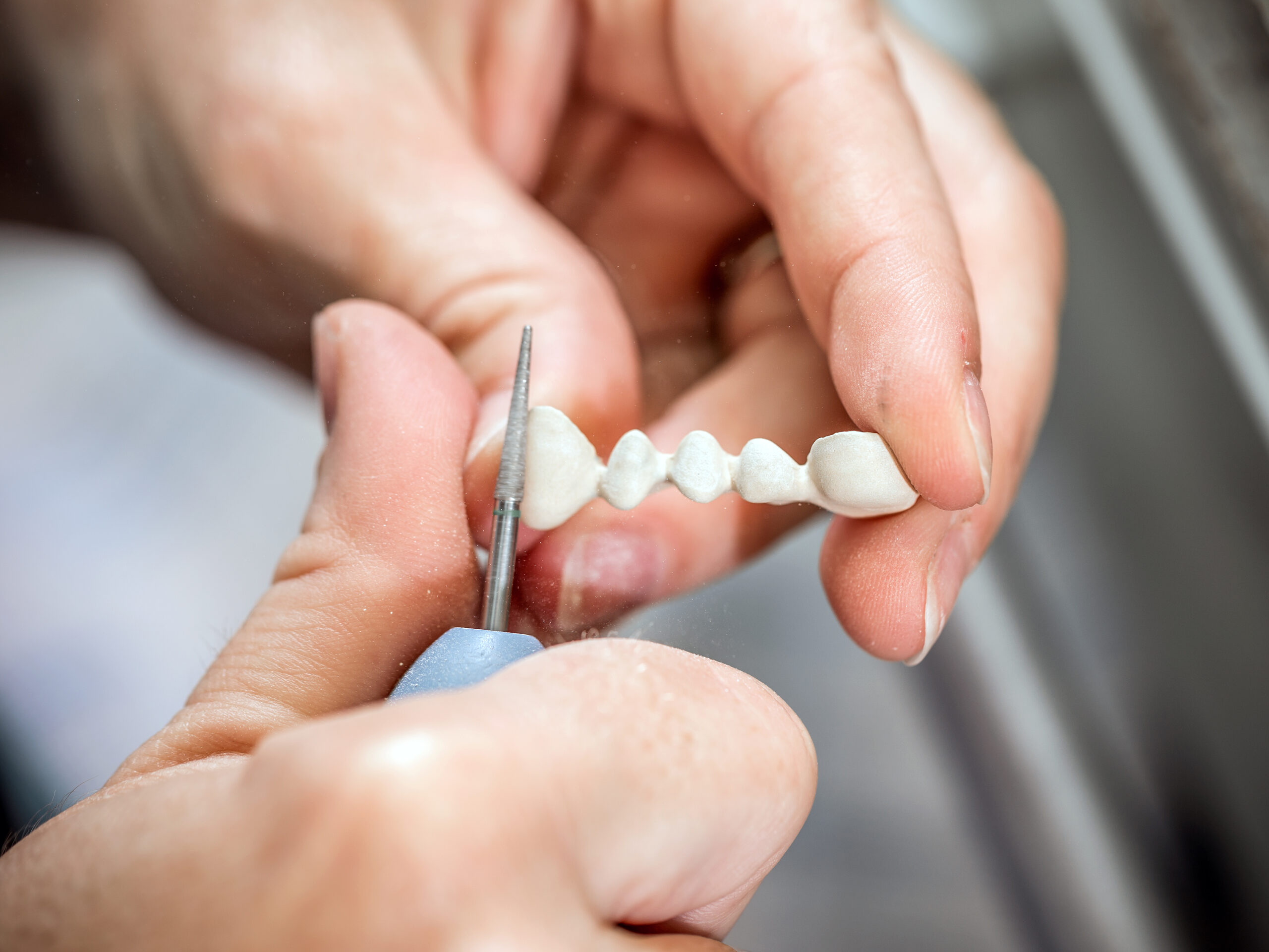 Modern Dental Crowns Look More Natural Than Ever